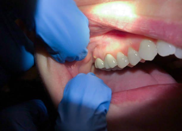 Best Emergency Root Canal Treatment in Jamestown, ND